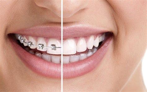 what are the cheapest invisible braces